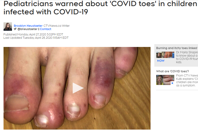 儿科医生警告说，感染了COVID-19的儿童可能患上“COVID toes”